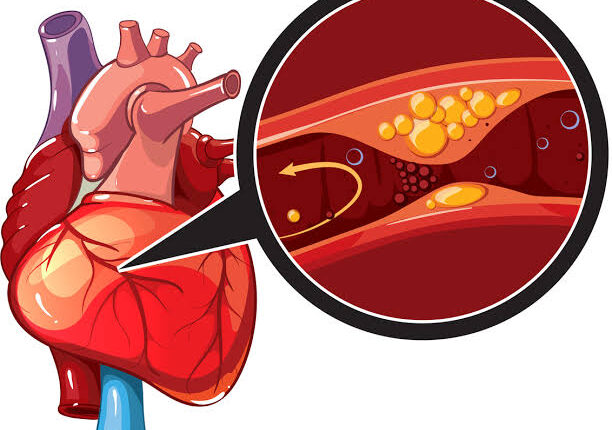 انسداد الشرايين.. طبيب يحذر من علامات تظهر مع المشى أو صعود السلم - الوان اف ام